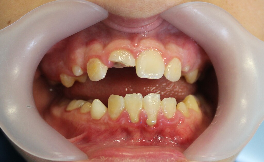 Fragmented Tooth Fractured tooth 11: treatment approach? - Cases and Questions - OsseoNews