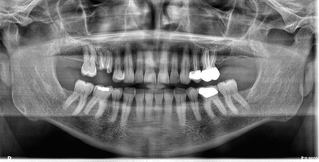 Immediate Implant for Maxillary Molar - Cases and Questions - OsseoNews