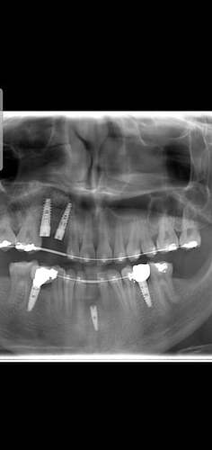 Implant too deep in my lower jaw? 1