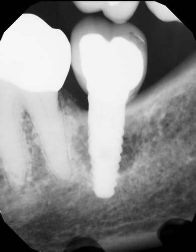 Unusual bone loss around implant: suggestions? 1
