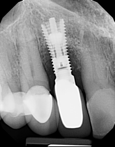 Implant X-ray #7