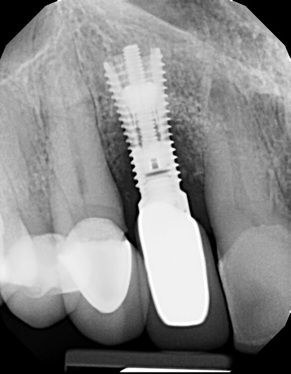 Expandable Implant #7 - Cases And Questions - OsseoNews