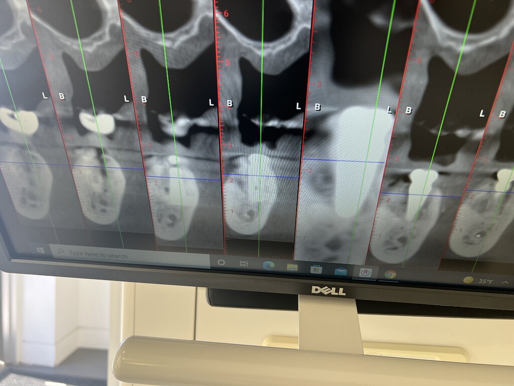 numbness-after-implant-and-bone-graft-options-cases-and-questions