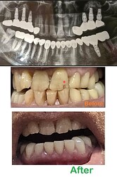 Front Teeth_before and after pics