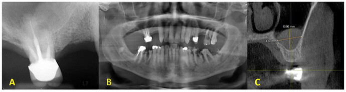 sinus-prf-1