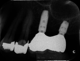 short-standard-implant