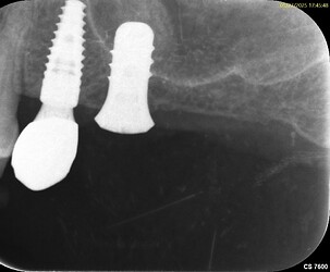 Immediate Sinus