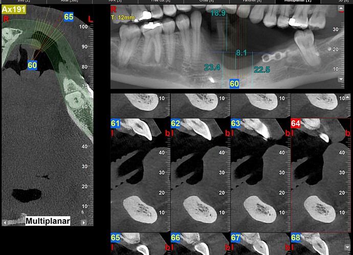 ridgway mandible