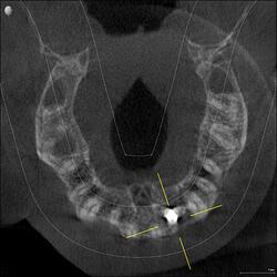 STDRIES_3D examination(1)_Volume_20260527_081712_Axial (from above)
