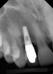 AP Implant 2_2