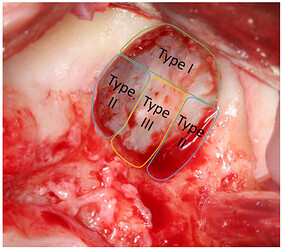 diagram-sinus-floor-perforation