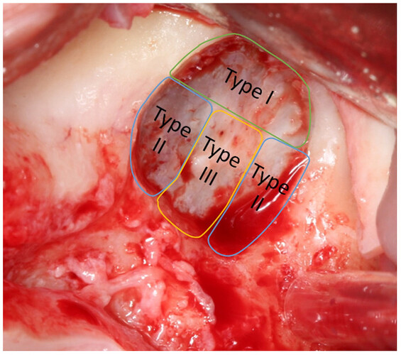 diagram-sinus-floor-perforation