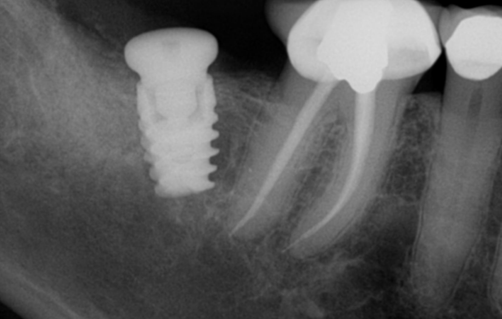 Misangulated implant? What would you have done?