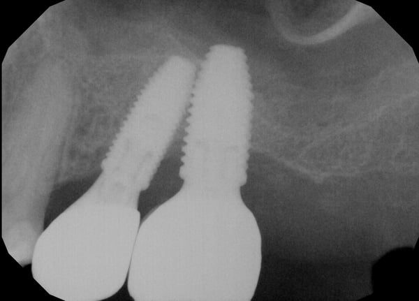 Implants were placed too close, keep or remove? 1