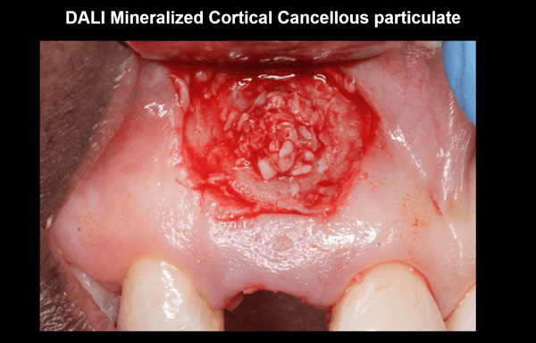 Regenerating Fenestration Defects during Extraction and Implant Placement 2