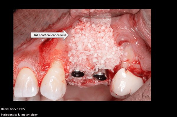 Trusting the Process: Removal of Odontoma, GBR, and Placement of Keystone Paltop Implants 3
