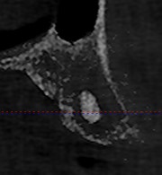 Removing a Retained Root: Technique and Procedure? 3