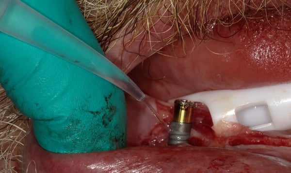 How do you treat Peri-Implantitis? 4