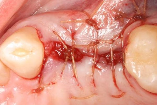 Immediate Implant Placement with Modified Palatal Roll 2