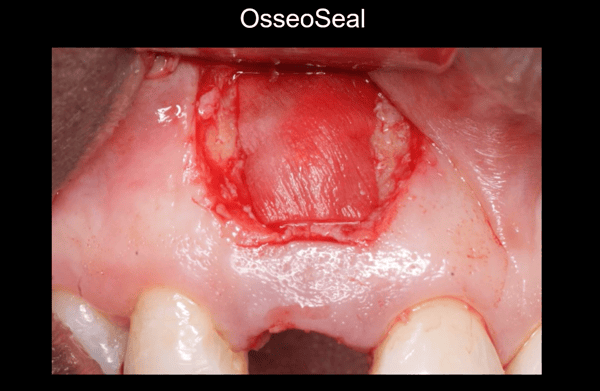 Regenerating Fenestration Defects during Extraction and Implant Placement 3