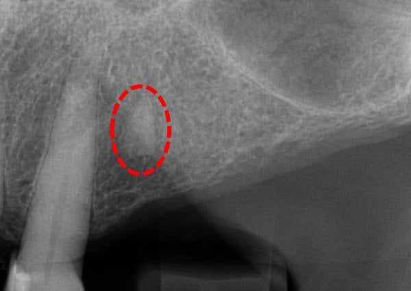 Removing a Retained Root: Technique and Procedure? 2