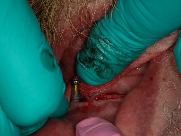 How do you treat Peri-Implantitis? 2