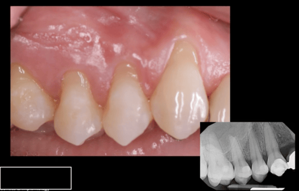 DALI Dermis for Soft Tissue Grafting 1