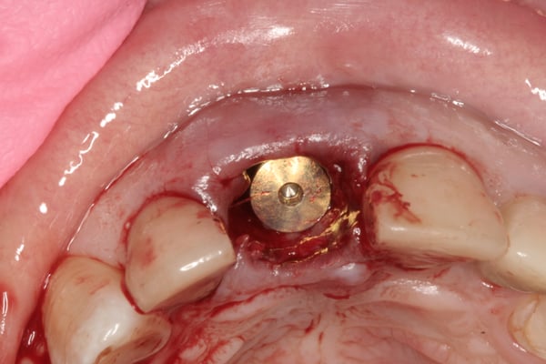 Immediate implants: Do you graft the space? 1