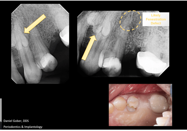 Trusting the Process: Removal of Odontoma, GBR, and Placement of Keystone Paltop Implants 1