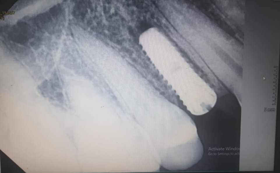 Immediate implant with 24