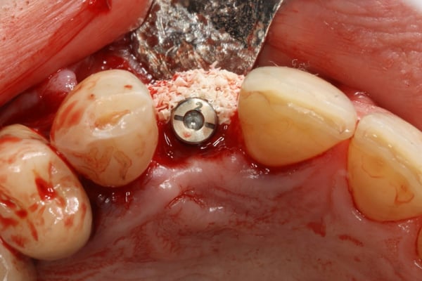 The Management of a Hopeless Maxillary Anterior Tooth Part II: Implant Placement and Restoration 4