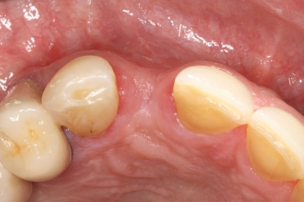 The Management of a Hopeless Maxillary Anterior Tooth: Part I 5