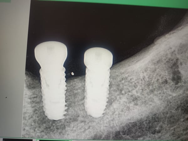 Post implant placement complication after 1 month? 2