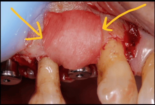 Membrane Adaptability: Using OsseoSeal for Buccal Contour Augmentation 1