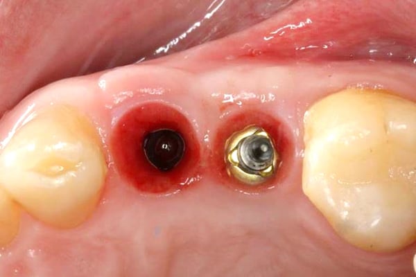 Immediate Implant Placement with Modified Palatal Roll 6