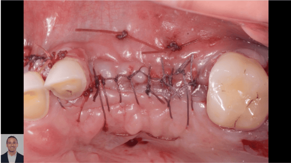 Suturing for Tension-Free Primary Wound Closure 2