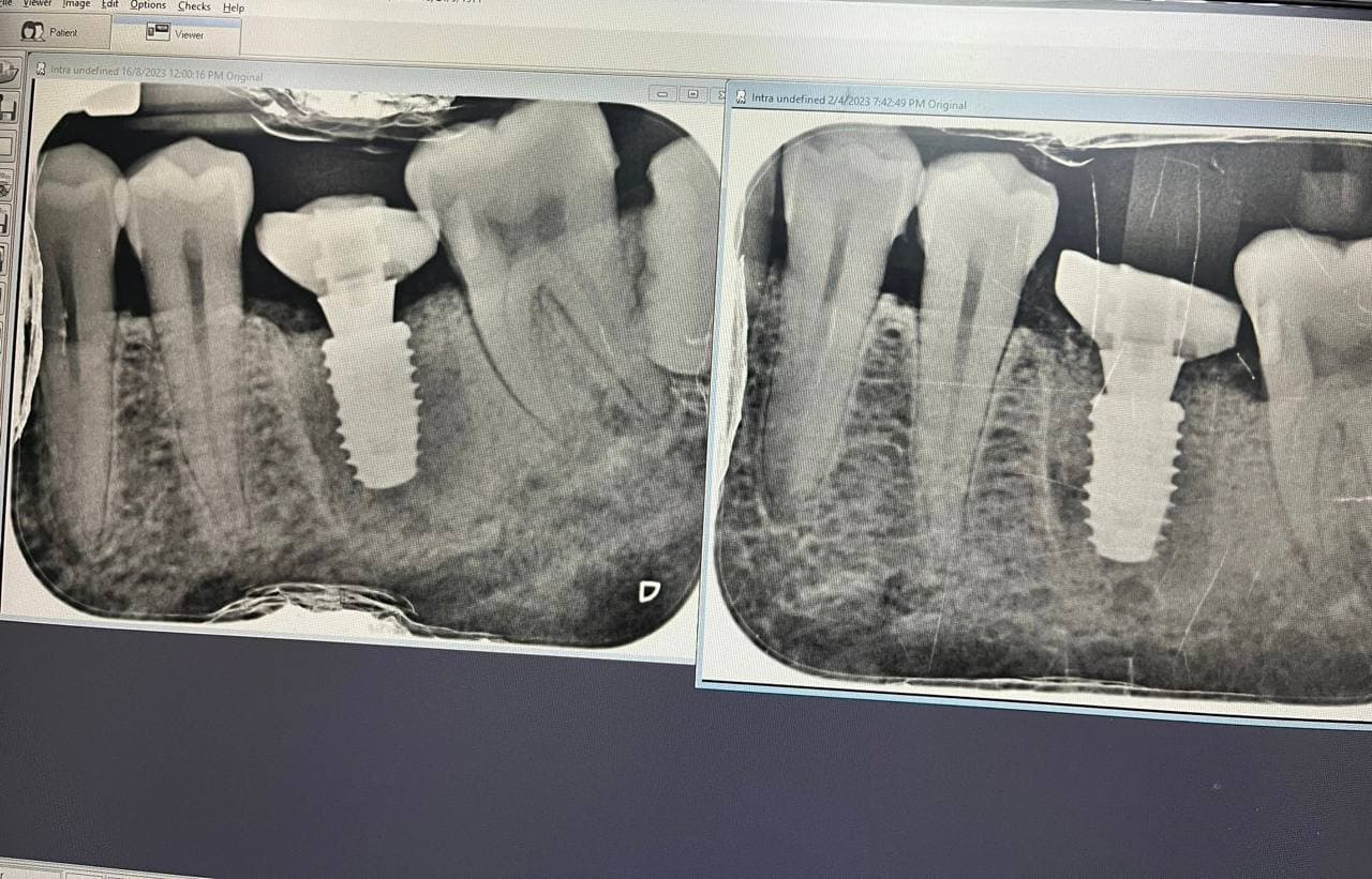 Is this immediate implant failing?
