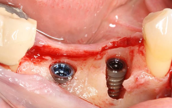 Immediate Implant Placement with Guided Bone Regeneration 3
