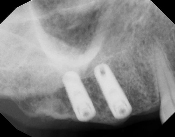 No Space: Options for Implant Restoration? 2