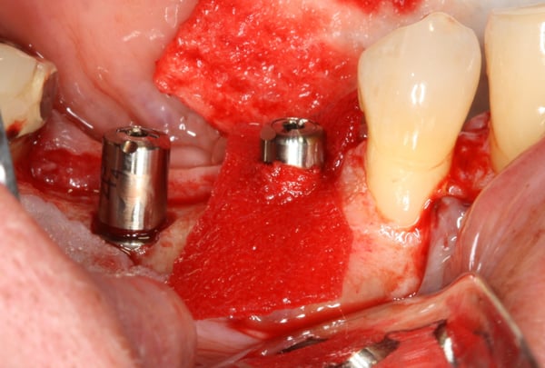 Immediate Implant Placement with Guided Bone Regeneration 4