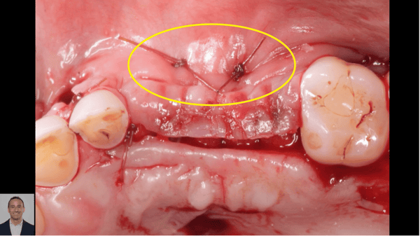 Suturing for Tension-Free Primary Wound Closure