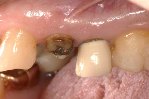 Immediate Implant Placement with Modified Palatal Roll 1