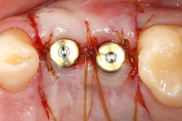 Immediate Implant Placement with Modified Palatal Roll 5