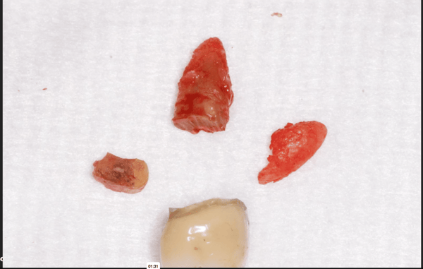 Maxillary Molar Extraction Technique: Decoronation and Sectioning 2