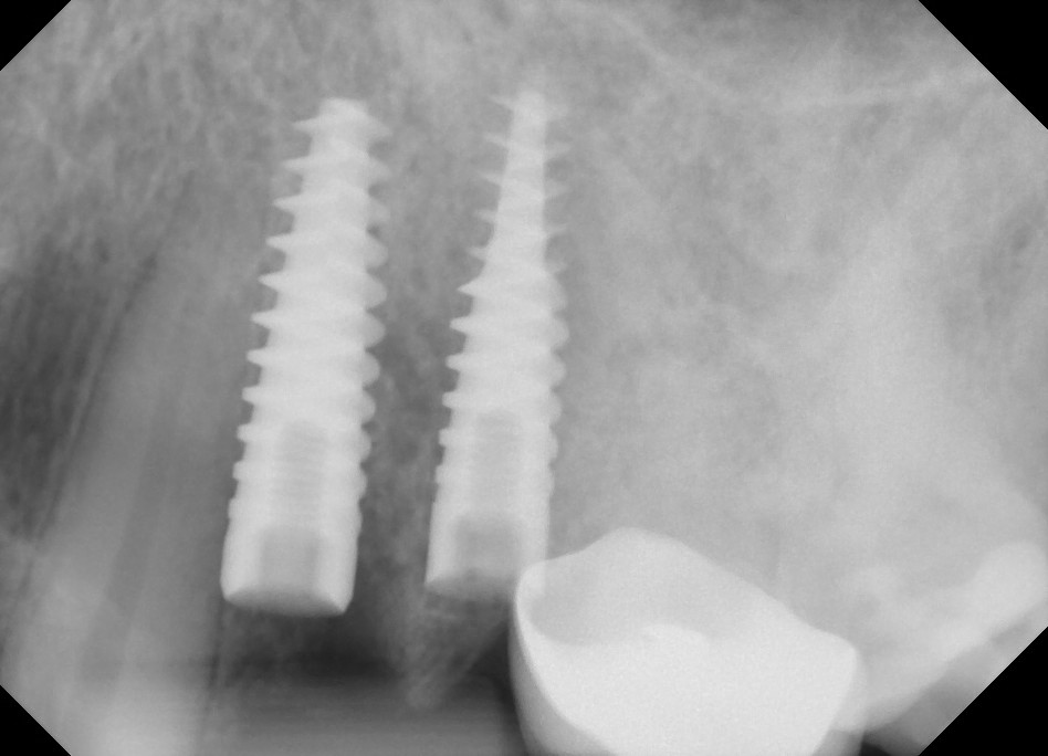 Accurate view of root to implant relationship?