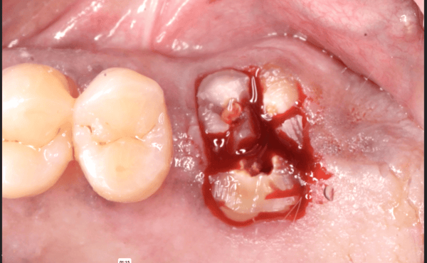 Maxillary Molar Extraction Technique: Decoronation and Sectioning