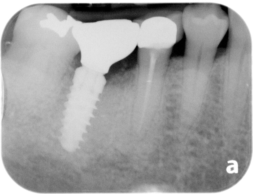 Teeth chattering after implant crown delivery?