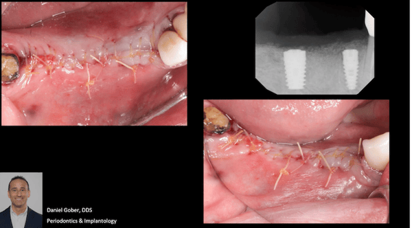 Bone Regeneration of Extensive Socket Defects with Immediate Implant Placement 4