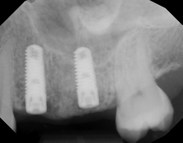 No Space: Options for Implant Restoration? 4