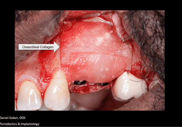Trusting the Process: Removal of Odontoma, GBR, and Placement of Keystone Paltop Implants 4
